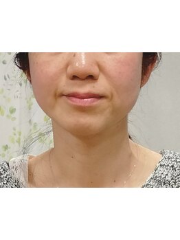 ホウレイ線・たるみ改善！予防ケア