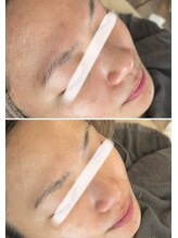 美時雨/毛穴にお悩みの方！