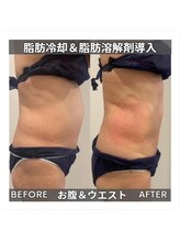 セターナルエス(Seternal.S)/脂肪冷却＆脂肪分解剤導入