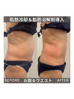 セターナルエス(Seternal.S)/脂肪冷却&脂肪分解剤導入