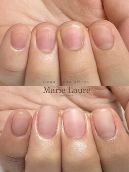 マリーロール 梅田店(Marie Laure)/自爪育成/深爪矯正/ネイルケア