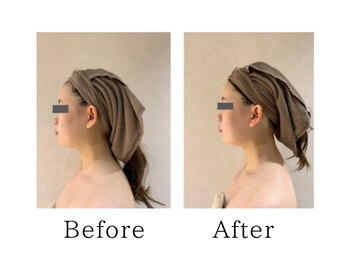 銀座レイア/【小顔矯正ビフォーアフター】