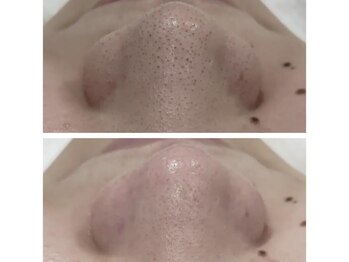 シェリーガーデン/ハイドラフェイシャル