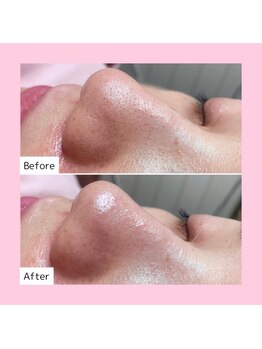 ホワイトラボ ライカム前店(White labo)/【施術例】毛穴洗浄ピーリング