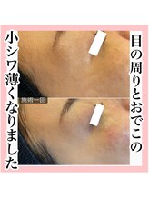 エクラーレ(Eclale)/ハーブピーリング症例