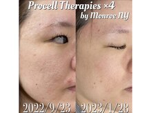 シルク ド ココ(Silk de Coco)/プロセルセラピーズフェイシャル