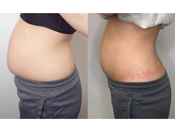 プルメリア(Plumeria)/マグニート約3ヶ月経過