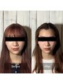 オアシス トウキョウ 心斎橋(OASIS TOKYO) OASIS式輪郭縮小術 4回【小顔/小顔矯正/美容鍼】