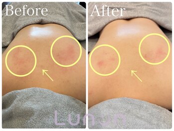 ルノン(Lunon)/背中ララピール