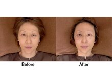 こじま 富雄団地接骨院/たるみ改善