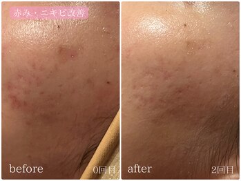 テン(10ten)/赤み・ニキビ改善