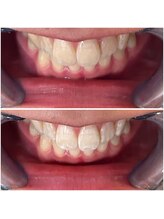 エクシアホワイトニング 代々木店/ホワイトニングビフォーアフター