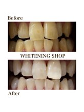 ホワイトニングショップ 徳島藍住店/Before After美白ホワイトニング