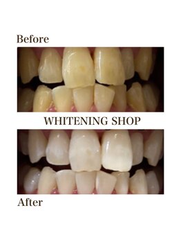 ホワイトニングショップ 徳島藍住店/Before After美白ホワイトニング