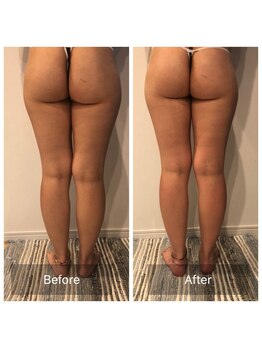 レガリア(LEGAREA)/一回施術でのキャビ・ラジオ波