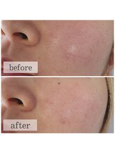 リブ(Lib)/水光白玉フェイシャル