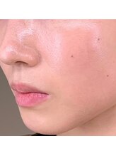 レプス(Lepus)/ハーブピーリング(5～7日)