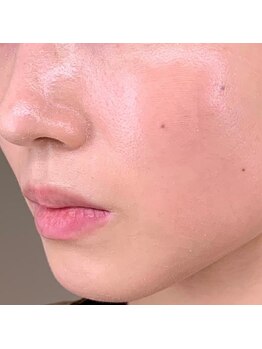 レプス(Lepus)/ハーブピーリング(5~7日)