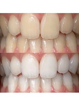 レイール(Reir)/【歯科提携】歯科監修ジェル