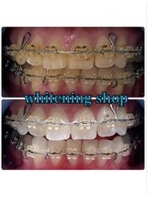 ホワイトニングショップ 鳥取店/ホワイトニングビフォーアフター