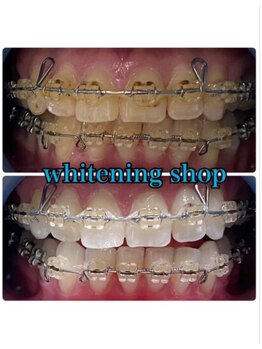 ホワイトニングショップ 鳥取店/ホワイトニングビフォーアフター