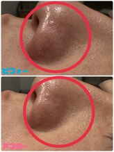 ソウ(SOU)/ハーブピーリング1回の効果