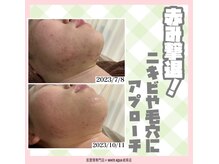 ホワイトアクア 岐阜店(WHITE AQUA)/ハーブピーリング/岐阜/毛穴