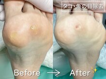 ディオフット(DIO FOOT)/タコ・魚の目を徹底除去◎