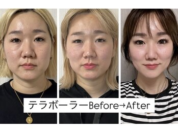 ティアラ(TIARA)/【小顔、たるみ】テラボーラー