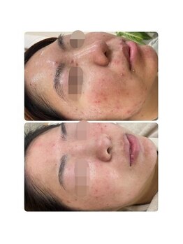 ニキビケア研究所 吉祥寺店/唇の上は腸のバランスの崩れです