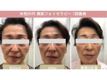 ヨロン(YORON)/あらゆる悩みに光フェイシャル！