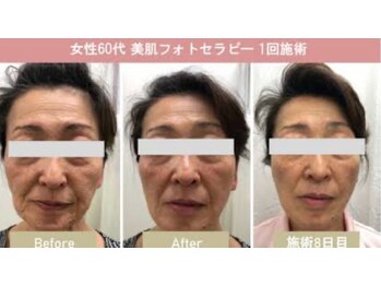 ヨロン(YORON)/あらゆる悩みに光フェイシャル！