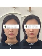 ハリナチュレ 西心斎橋店(HARINATURE)/Before After