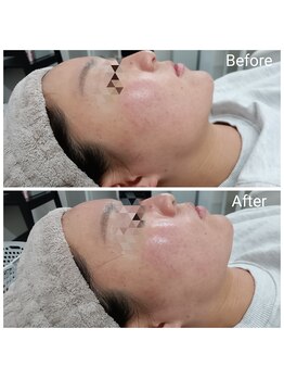 Beauty salon Ren/ゾンビ＆ハイドロジェリーマスク