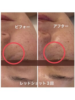 ランティル(l’until)/【目の下のたるみが目立たなく】