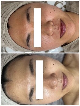 ソフィア わさだ店/20代セルマン肌質改善20回