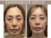 ドクターボディ 恵比寿店(Dr.Body)/【ほうれい線/頬のたるみ】