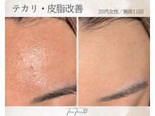 スリースリー 恵比寿(THREE THREE)/テカリ・脂性肌ケア