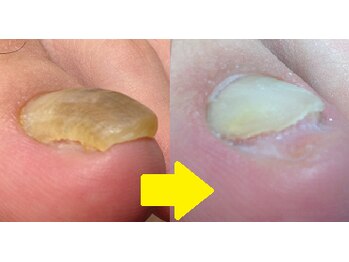 ドクターネイル爪革命 秋津店/肥厚爪のケア