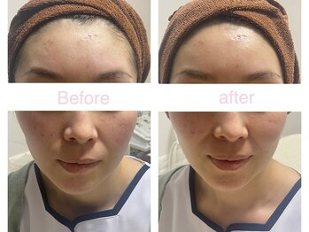 サクラ 伊勢原店(SAKURA)/1回でも効果絶大のフェイシャル