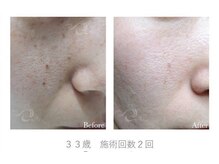 クリア 麻布十番(CLEAR)/ピーリング　毛穴ケア　乾燥肌