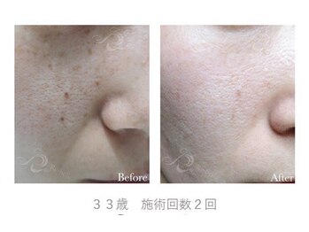 クリア 麻布十番(CLEAR)/ピーリング　毛穴ケア　乾燥肌