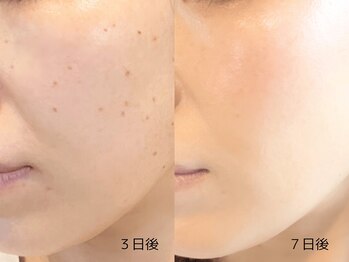 アンドアンド(&and)/【シミケア経過3~7日後】