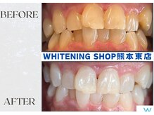 ホワイトニングショップ熊本東店/ホワイトニングショップ熊本東店