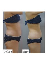 アップルミント/＜痩身＞before・after