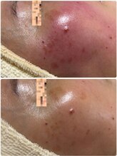 トータルビューティー ココ(Total Beauty CoCo)/50代・赤み改善