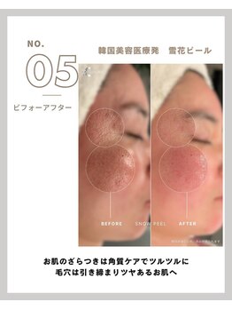 ラ メール(La mer)/★雪花ピール BeforeAfter★