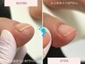 【口コミ投稿限定】巻き爪補正1ヵ所(症状で料金変動)90分5500円～