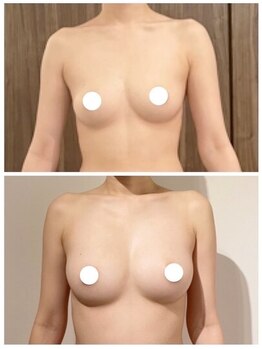 IBC 横浜馬車道店/バストアップBeforeAfter