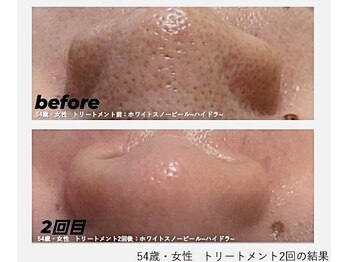 ロロメ(Rorome)/ビフォー/アフター(毛穴)